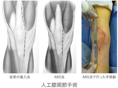 人工膝関節手術