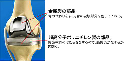 図：変形性膝関節症