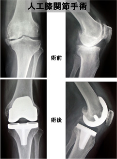 図：人工膝関節手術