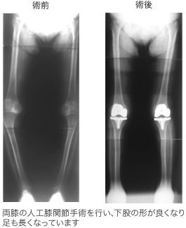 図：人工膝関節術後