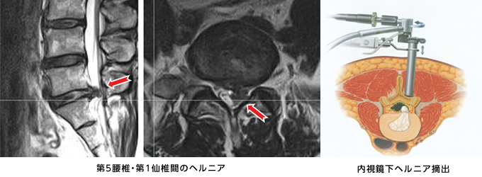 画像：内視鏡下椎間板摘出術（MED）