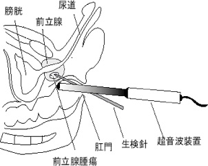 画像：図2　前立腺生検の方法